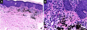 Padrão liquenoide. Hiperplasia epidérmica, ortoceratose, camada de Malpighi com espongiose e ceratinócitos disceratóticos dispersos. Degeneração vacuolar da camada basal da epiderme. Na derme, há infiltrado inflamatório em faixa subepidérmica com alguns corpos citoides contendo pigmento preto (Hematoxilina & eosina, [A] 100×, [B] 400×). Arquivo fotográfico do Laboratório de Dermatopatologia da Seção de Dermatologia da Universidad de Antioquia.