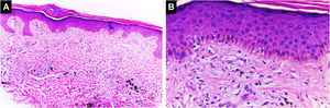 Dermatite espongiótica. Espessura da epiderme preservada com espongiose e alguns ceratinócitos disceratóticos. Degeneração vacuolar da camada basal da epiderme. Pigmento preto é identificado na derme (Hematoxilina & eosina, [A] 100×, [B] 400×). Arquivo fotográfico do Laboratório de Dermatopatologia da Seção de Dermatologia da Universidad de Antioquia.