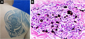 Inflamação granulomatosa do tipo sarcoide. (A) Lesões papulonodulares em tatuagem na região escapular direita. (B) Infiltrado granulomatoso do tipo sarcoide associado a pigmento de cor preta (Hematoxilina & eosina, 400×). Estudos sistêmicos revelaram sarcoidose. Arquivo fotográfico do Laboratório de Dermatopatologia da Seção de Dermatologia da Universidad de Antioquia.