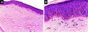 Padrão esclerodermiforme/similar à morfeia. A epiderme parece inalterada em espessura. Na derme observa‐se fibrose com ausência de anexos cutâneos associada à deposição de pigmento de cor preta (Hematoxilina & eosina, [A] 100×, [B] 400×). Arquivo fotográfico do Laboratório de Dermatopatologia da Seção de Dermatologia da Universidad de Antioquia.