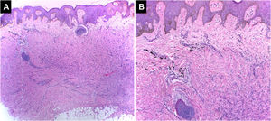 Dermatofibroma. Derme contendo neoplasia de células fusiformes, não encapsulada com discreta atipia citológica, circundada por pigmento de cor preta. A epiderme apresenta hiperplasia pseudoepiteliomatosa (Hematoxilina & eosina, [A] 40×, [B] 100×). Arquivo fotográfico do Laboratório de Dermatopatologia da Seção de Dermatologia da Universidad de Antioquia.