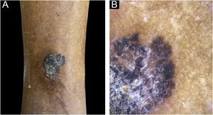 (A) Região de face lateral inferior da perna direita com placa enegrecida de 4cm de diâmetro e superfície hiperceratósica; na porção anterossuperior, presença de área com pigmento acastanhado. (B) Dermatoscopia da região anterossuperior da lesão apresentando escamocrostas na superfície e presença de estrias radiadas e pseudópodes na periferia.