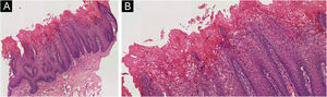 (A) Fotomicrografia com coloração de Hematoxilina & eosina (H&E) de amostra de mucosa bucal esquerda de mulher de 61 anos demonstrando acantose moderada com alongamento regular dos cones epiteliais e edema intracelular (Hematoxilina & eosina, 40×). (B) Algumas células disceratóticas exibindo condensações eosinofílicas paranucleares (Hematoxilina & eosina, 400×).