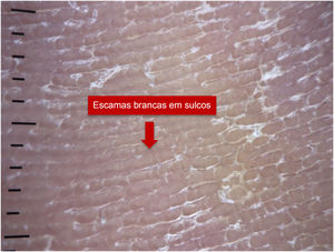 Dermatoscopia de paciente portador de tinea pedis.