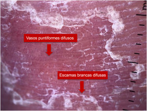 Dermatoscopia de paciente portador de psoríase.