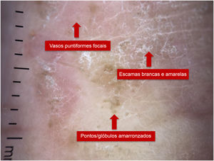 Dermatoscopia de paciente portador de eczema palmar.