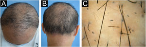 Características clínicas e dermatoscopia da probanda. O probando exibia cabelos ralos (A) e hiperceratose folicular (B). (C) A dermatoscopia do probando mostrou aspecto em contas de rosário e nódulos típicos.