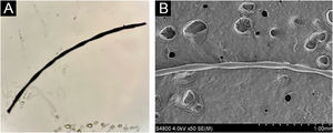 Microscopia óptica e microscopia eletrônica de varredura da probanda. (A) O exame da haste capilar do probando com microscópico óptico mostrou nódulos elípticos característicos e constrição intermitente. (B) A microscopia eletrônica de varredura revelou que o cabelo cilíndrico tinha estrutura segmentar com nódulos periódicos e partes estreitas.