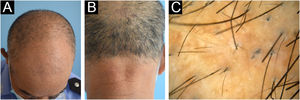 Características clínicas e dermatoscópicas do pai. Notam‐se cabelos ralos (A) sem hiperceratose folicular (B). (C) A dermatoscopia revelou fragilidade e quebra dos cabelos.