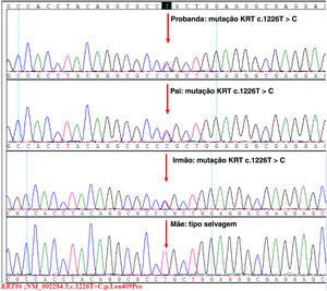 Sequência da mutação em heterozigose emKRT86.A probanda, seu pai e seu irmão tinham mutação em heterozigose de T para C (c.1226T>C, p.Leu409Pro) no éxon 7 deKRT86. A sequência da mãe era normal.