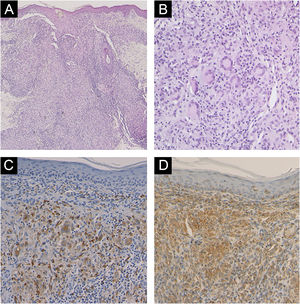 (A) Características histopatológicas mostrando granulomas de células epitelioides na derme. (B) Em grande aumento obervam‐se granulomas dérmicos compostos por células epiteloides e células gigantes multinucleadas. Análise imuno‐histoquímica revelou positividade para CD68 (C) e CD163 (D).