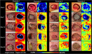 Imagens clínicas (painéis à esquerda) e LSCI (painéis à direita) de enxertos de pele de espessura total no couro cabeludo dos quatro pacientes. As imagens de LSCI mostram diferenças na perfusão em escala semiquantitativa, do preto (sem perfusão) ao vermelho (perfusão intensa). O paciente 1 apresentava leito receptor azulado a preto no D0, e o enxerto permaneceu mal perfundido até o D28, culminando com necrose subtotal do enxerto. O paciente 2 apresentava leito de enxerto azulado (baixa perfusão), mas recuperou‐se gradualmente ao longo de quatro semanas, e a área de necrose do enxerto foi inferior a 50%. Os pacientes 3 e 4 apresentaram leitos de enxerto melhor perfundidos e apresentaram perfusão acentuada a partir do D14. No D28, a extensão da necrose era de 16% e 9%, respectivamente. LSCI, laser speckle contrast imaging; UPA, unidades de perfusão arbitrária.