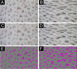 Fios de cabelo cobrindo a área do couro cabeludo analisados antes (A) e após (D) 36 horas para obter a velocidade de crescimento do cabelo. * (A) Foto obtida no início da intervenção. (B) Figura A com filtragem de mediana. (C) Segmentação dos fios da foto inicial em A. (D) Foto obtida 38 horas após A da mesma área. (E) Figura D com filtragem de mediana. (F) Segmentação dos fios a partir da foto inicial em D.