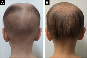 (A) Fotografia clínica de paciente pediátrica com pRIA e pCIA antes do tratamento, mostrando alopecia difusa com cabelos finos. (B) Imagem clínica da mesma paciente após um ano de tratamento com MOBD mostrando melhora da densidade dos cabelos.