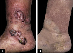 Exame físico. (A) Exame físico inicial. Nódulos com ulceração superficial no terço inferior da perna direita de 0,5‐1cm, coalescentes, formando placas de 4‐5cm. (B) Exame físico após três meses de terbinafina. Hiperpigmentação residual na perna direita.