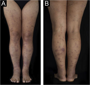 Múltiplos nódulos eritematosos e edematosos nos membros inferiores. (A) Visão anterior. (B) Visão posterior.