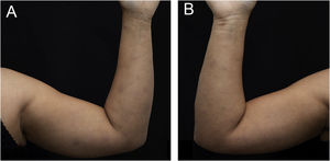 Múltiplos nódulos eritematosos e edematosos nos membros superiores. (A) Face medial, membro superior esquerdo. (B) Face medial, membro superior direito.