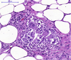 Exame histopatológico mostrando paniculite linfocítica septal, sem vasculite, formação de granulomas e presença de células gigantes multinucleadas.