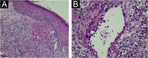 (A) Acúmulo de neutrófilos na derme papilar (setas) – Hematoxilina & eosina, 200×. (B) Vasculite com necrose fibrinoide da parede com neutrófilos (Hematoxilina & eosina, 400×).