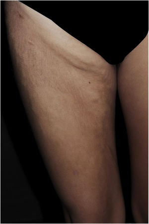 Síndrome Stiff Skin. Paciente do sexo feminino, 19 anos, com placas escleróticas com padrão em pedra de calçamento na coxa e região inguinal direita.