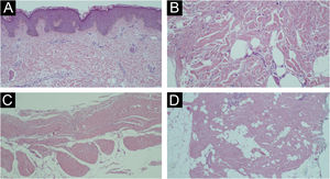 Coloração Hematoxilina & eosina. (A) Ausência de inflamação significante. (B) Espessamento e horizontalização das fibras colágenas e discreta mucinose dérmica. (C) Esclerose e densificação da fáscia. (D) Aprisionamento de adipócitos e espessamentos dos septos.