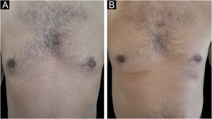 Paciente com pitiríase versicolor crônica. (A) Antes do tratamento. (B) Após oito semanas de tratamento com isotretnoína oral com dose baixa/semanal.