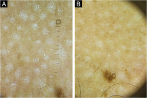 Dermatoscopia com luz polarizada em paciente com pitiríase versicolor crônica. (A) Máculas circulares centradas nos folículos pilosos, com presença de descamação após manobra de Zirelí compatível com doença em atividade. (B) Após oito semanas de tratamento com isotretinoína oral, nota‐se redução de número e tamanho das lesões, ausência da descamação após manobra de Zirelí, compatível com hipocromia pós‐inflamatória em resolução (Dermatoscópio DL5 Dermlite®,10×).