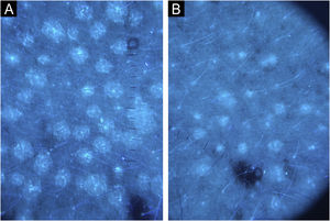 Dermatoscopia com luz de Wood (10×) em paciente com pitiríase versicolor crônica. (A) Nota‐se com maior precisão a hipocromia e descamação pré‐tratamento compatível com atividade de doença. (B) Pós‐tratamento com redução do número e tamanho das máculas, além de ausência de descamação, compatível com hipocromia pós‐inflamatória em resolução (Dermatoscópio DL5 Dermlite®,10×).
