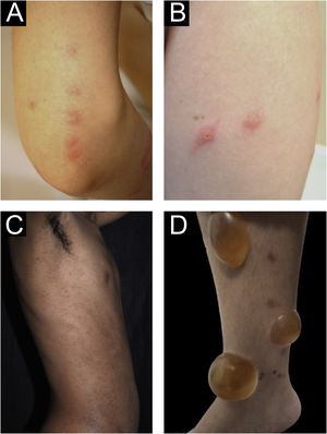 (A) Prurigo agudo no antebraço em virtude de picadas de percevejos em morfologia de padrão linear típico semelhante ao café da manhã, almoço e jantar. (B) Prurigo agudo decorrente de picada de inseto (prurigo estrófulo). (C) Prurigo agudo extenso por escabiose. (D) Bolha após prurigo agudo em virtude de picadas de insetos.