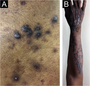 Prurigo crônico (PGC) e a morfologia elementar de lesões. (A) Pápula (< 1cm de diâmetro) e nódulos (> 1cm de diâmetro). (B) Coalescência de pápulas e nódulos (placa) e lesões em arranjo linear.