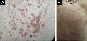 Prurigo crônico multiforme. (A) Múltiplas lesões papulares pruriginosas primárias geralmente se expandem ou coalescem para formar uma lesão em placa eritematosa infiltrada. (B) “Sinal da borboleta”, indicando área de pele dorsal poupada pela escoriação em virtude de inacessibilidade.