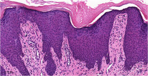 Exame histopatológico de paciente portador de prurigo crônico mostrando hiperceratose com paraceratose esparsa, acantose irregular, espongiose discreta, proeminência vascular nas papilas dérmicas, fibroplasia da derme superficial e infiltrado inflamatório linfocitário preferencialmente perivascular (Hematoxilina & eosina, 400×).