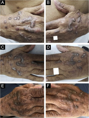 Evolução das lesões prurigo nodular crônico em homem de 87 anos antes (2019) e após tratamento com dupilumabe. A evolução sequencial dos nódulos hiperceratóticos infiltrados e escoriados isolados ou confluentes nas mãos do paciente. Aspecto direito (A) e aspecto esquerdo (B) na consulta inicial (observar erosões e escoriações sobre nódulos). (C e D) Menos lesões escoriadas ao final do primeiro mês de tratamento com dupilumabe. (E e F) Após quatro meses de monoterapia com dupilumabe, quando os nódulos infiltrados e hiperceratóticos apresentaram regressão expressiva e não foram observadas erosões ou escoriações. Após três anos de acompanhamento do tratamento com dupilumabe (2019‐2022), o paciente completou 91 anos, em uso de 300mg uma vez ao mês, e negou prurido; sua Escala Visual Analógica de prurido foi constantemente 0 nos últimos dois anos.