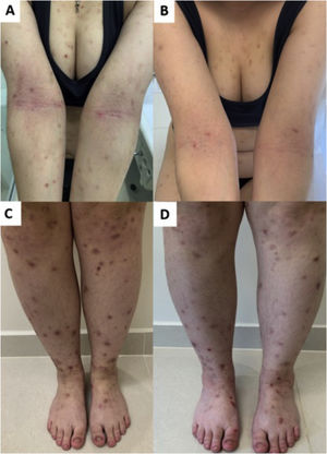 Resposta do prurigo nodular ao upadacitinibe. (A) Mulher com lesões eczematosas da dermatite atópica clássica nas dobras antecubitais e nódulos do prurigo nodular nos braços e membros inferiores (C). (B e D) Após 12 semanas de tratamento com upadacitinibe 30mg/dia, houve melhora importante das lesões eczematosas, do prurido e, consequentemente, do prurigo.