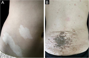 (A‐B) Máculas hipomelanóticas no abdme (A) e placa de Shagreen no dorso de paciente adolescente (B).