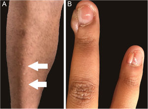 (A‐B) Lesões em confete (setas) na região anterior da tíbia (A) e fibromas ungueais no 4° e 5° quirodáctilos de paciente adulto (B).