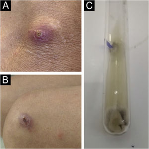(A) Aspecto clínico inicial com pústula. (B) Evolução para lesão ectimoide. (C) Cultura positiva para Sporothrix spp.
