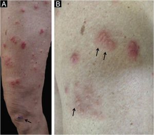 (A) Lesões disseminadas eritematosas. Note a lesão ectimoide na parte inferior (seta). (B) Detalhe das lesões com aspecto pseudovesicular (setas).