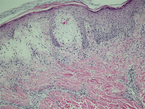 Microscopia óptica com edema marcado da derme superficial associado a infiltrado linfocitário e neutrofílico com extravasamento de hemácias. Ausência de espongiose, vasculite ou de dano vacuolar (Hematoxilina & eosina, 100×).