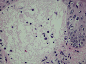 Detalhe do edema da derme papilar, correspondente à pseudovesícula (Hematoxilina & eosina, 400×).