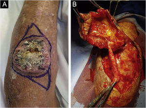 (A) Aspecto clínico do tumor. (B) Intraoperatório evidenciando grande vaso adentrando a lesão excisada.