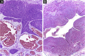 Achados histológicos do tumor da figura 1 (cortes em parafina, Hematoxilina & eosina). (A) Neoplasia em contato próximo com vasos derivados da fístula. (B) Fístula arteriovenosa desligada retirada durante a exérese.