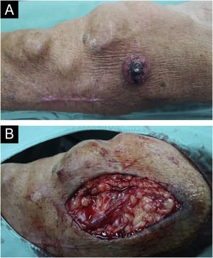 (A) Tumor próximo à FAV. Detalhe para cicatriz de exérese prévia de CEC. (B) Intraoperatório, vaso de calibre médio próximo ao território operado.