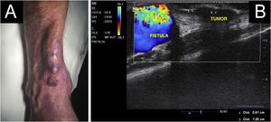 (A) Tumor localizado distal à FAV ativa. (B) Ultrassom dermatológico (Modo B e Doppler Mindray, probe linear 16 MHz), distando 0,6 cm da fístula ativa.