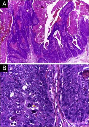 Histologia do tumor da figura 4 (cortes em parafina, Hematoxilina & eosina. (A) Neoplasia exofítica, com superficialização das papilas, abundante material córneo, como as verrugas (provável papel do HPV, pela imunossupressão). (B) Núcleos atípicos, embora alguns se destaquem mais pelo grau de hipercromasia. Presença de mitoses atípicas (seta amarela).