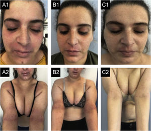 Caso 1. (A1‐A2) Estado basal: eczema grave, afetando principalmente face, região cervical e dobras cutâneas. Há eritema acentuado, formação de pápulas com algum exsudato e crostas e liquenificação no lábio superior e nas dobras cutâneas. (B1‐B2) Após 12 meses de dupilumabe: pequena melhora, mesmo após seis meses de tratamentos semanais. (C1‐C2) Após seis meses de traloquinumabe: pele quase limpa, permanecendo apenas pequena placa no lábio superior, com pouco eritema e liquenificação e alguma hiperpigmentação residual.