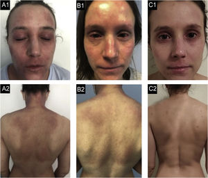 Caso 2. (A1‐A2) Estado basal: eczema grave, generalizado, com eritema acentuado, formação de algumas pápulas com exsudato e crostas, e liquenificação palpebral acentuada. (B1‐B2) Após nove meses de dupilumabe: falência secundária após melhora inicial com resposta parcial aos seis meses, com desenvolvimento de conjuntivite bilateral grave. (C1‐C2) Após três meses de traloquinumabe: melhora global, com pele quase limpa, apenas liquenificação residual em ambas as pálpebras e lábio superior.