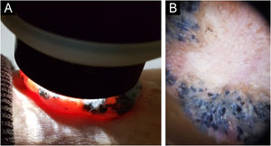 (A) Transluminescência da tumoração polipoide. (B) Na dermatoscopia, grandes ninhos ovoides azuis‐acinzentados na periferia da lesão, predominando áreas e linhas brancas brilhantes (crisálidas) ao centro, com ausência de telangiectasias arboriformes.