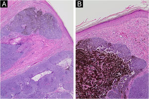 No detalhe, agregações neoplásicas basaloides com paliçada periférica e áreas de pigmentação (Hematoxilina & eosina, 40× e 100×, respectivamente).