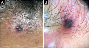 Exame físico. (A) Pápula de cor marrom‐escura. (B) Dermatoscopia. Ninhos ovoides azul‐acinzentados e ulceração, circundados por borda eritematosa elevada de 3mm.